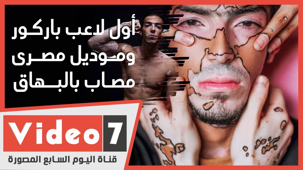 أول لاعب باركور وموديل مصري مصاب بالبهاق