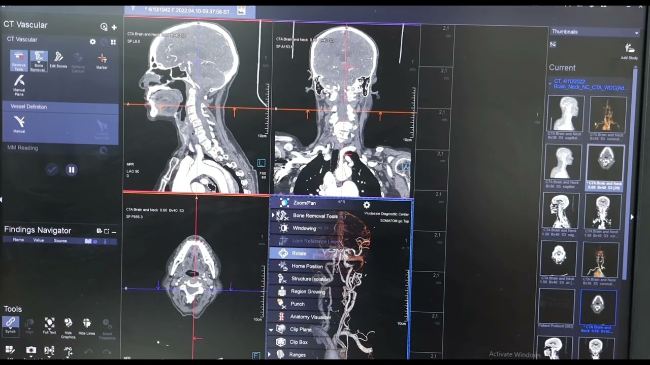 SIEMENS  SOMATOM go.top CT Vascular