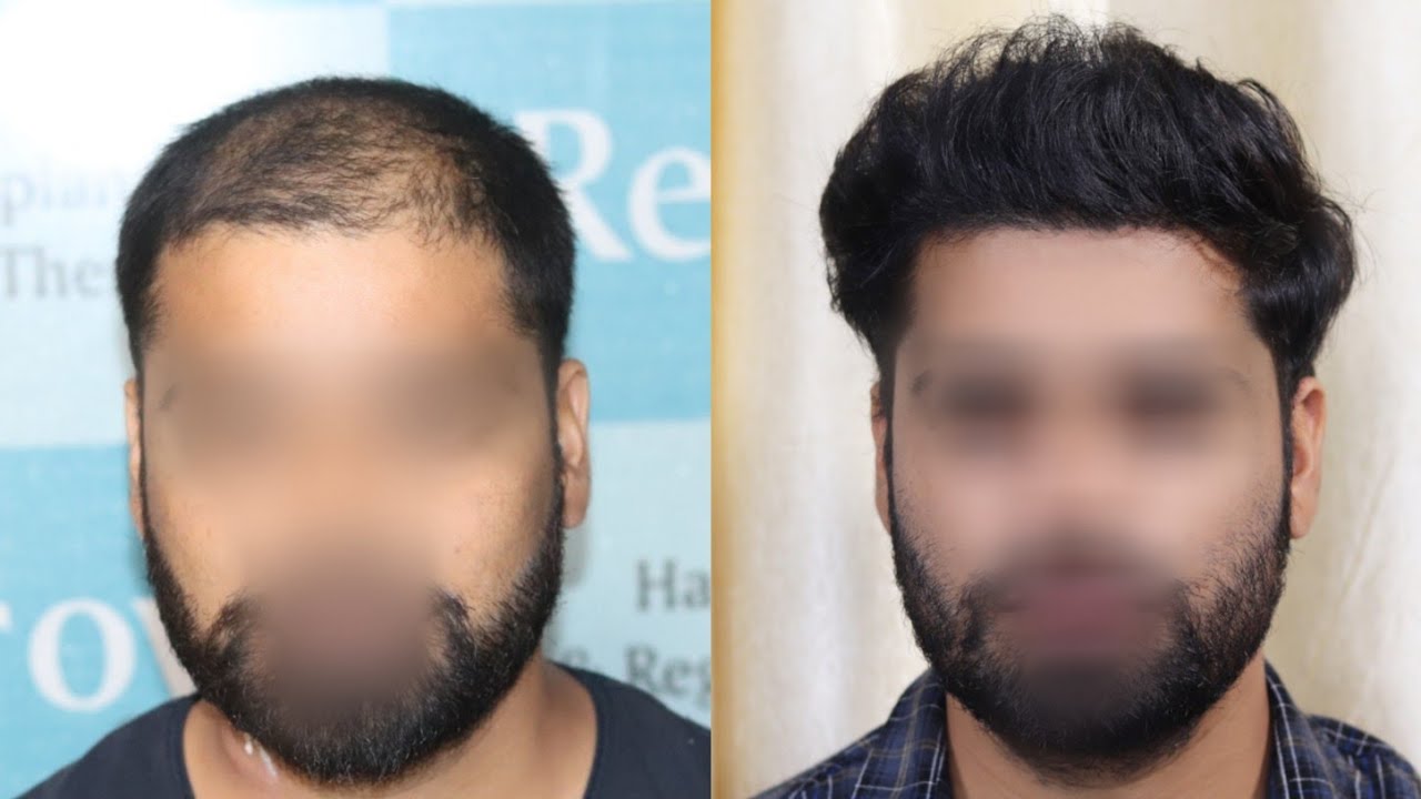 Best Hair Transplant Result 2020 || Diffuse Pattern || 4,200 Grafts || Regrow Clinic Haridwar