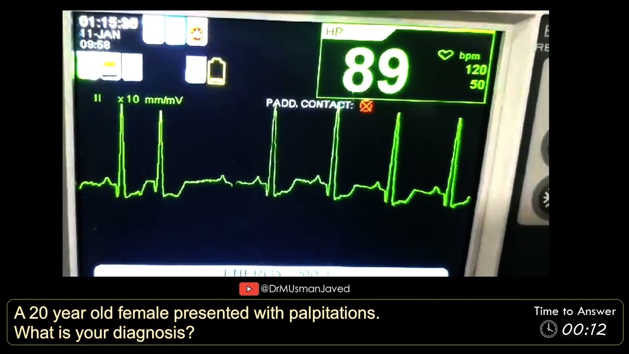 Telemetry - Patient with Palpitations #Ecg #Cardiology 