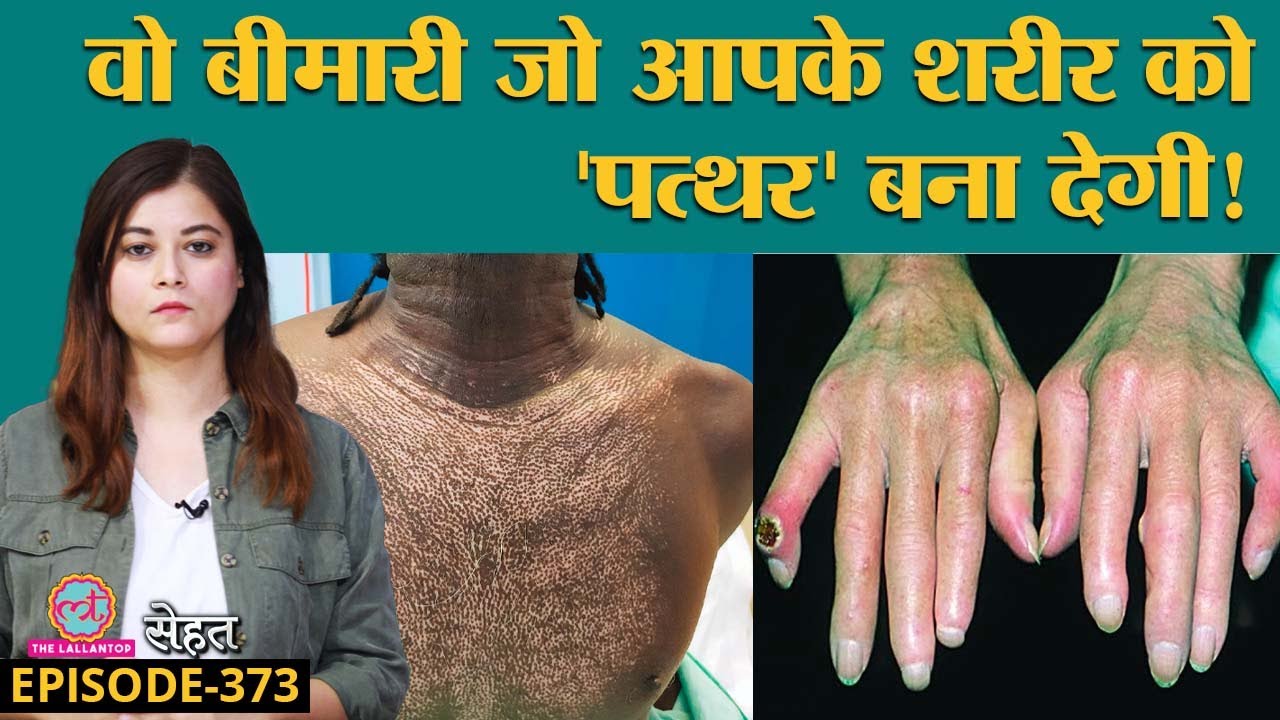 Scleroderma वो बीमारी जिसमें Skin पत्थर जैसी हो जाती है, कैसे बचें? | Sehat ep 373