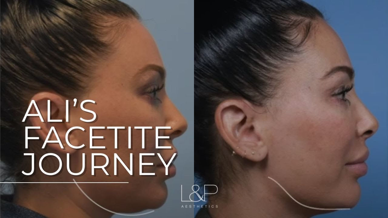 FaceTite Journey at L&P Aesthetics | Palo Alto, CA