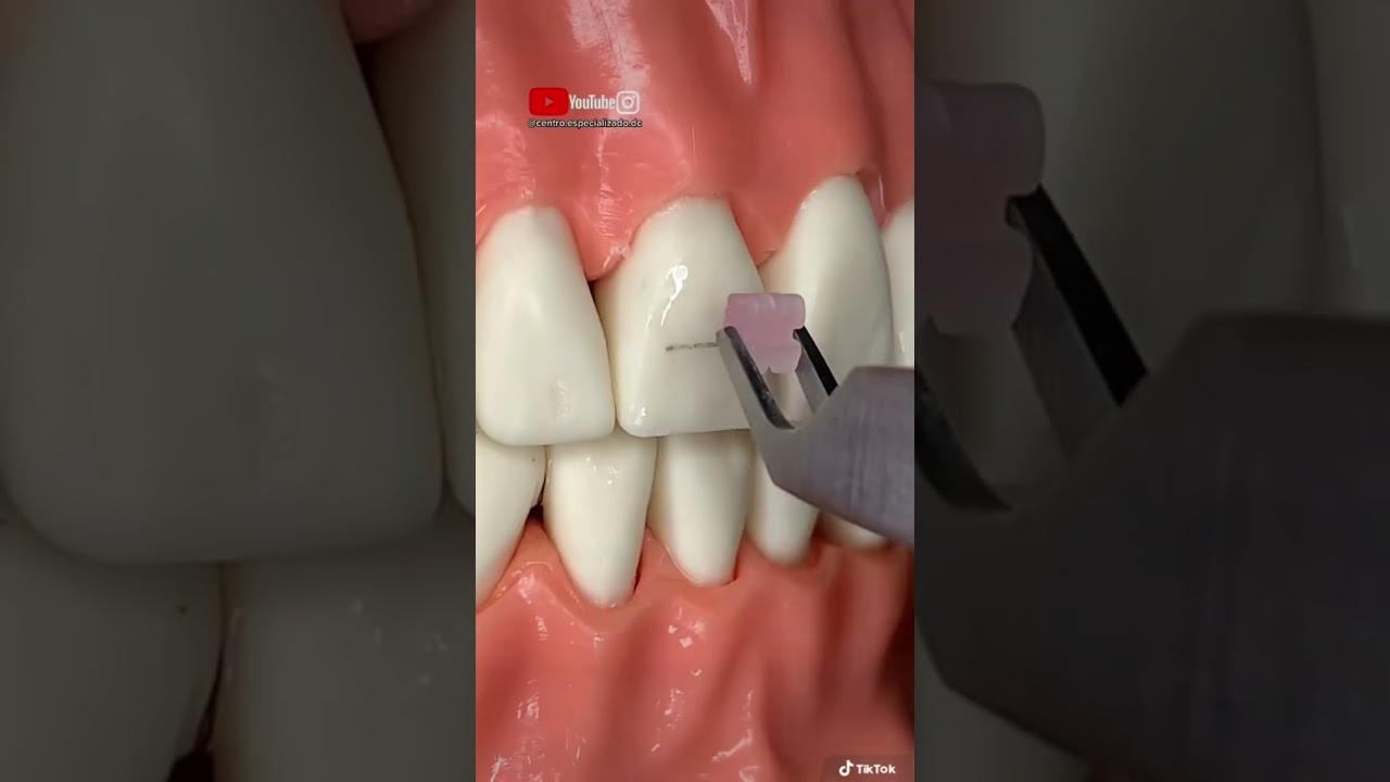 &iexcl;Proceso completo para instalar BRACKETS EST&Eacute;TICOS!