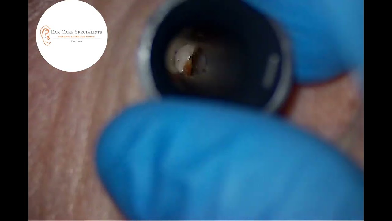 Huge wax lump removed from patient's ear. #ear #earwax #earwaxremoval #cerumen #satisfying #audpeeps