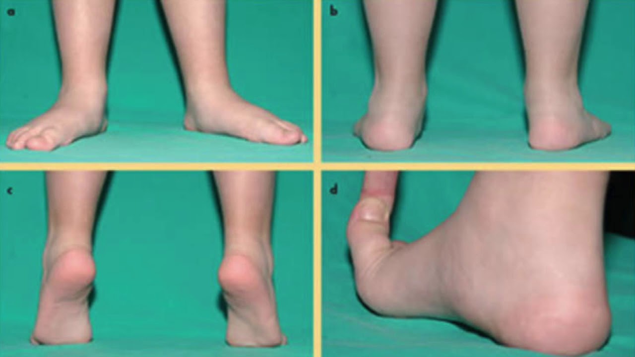 PROBLEMAS ORTOPEDICOS COMUNES EN NIÑOS