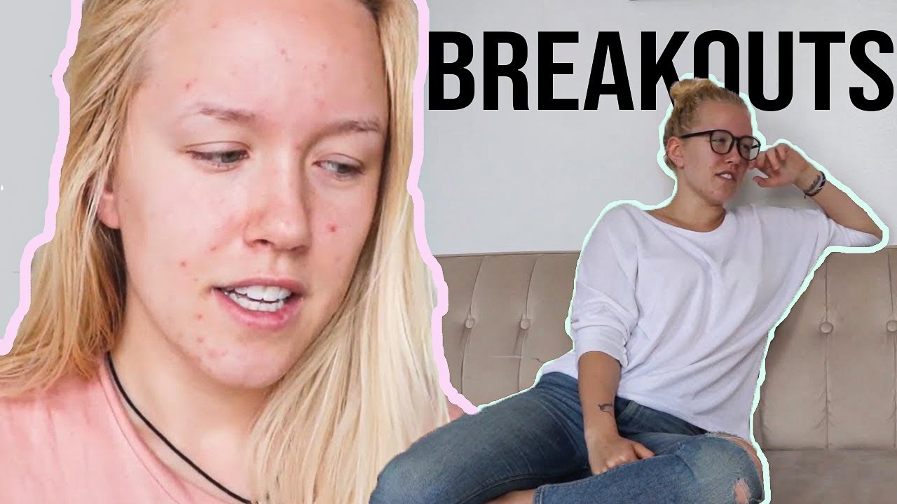 Embracing your insecurities (acne and breaking out)