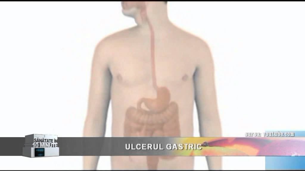 Ulcerul gastric