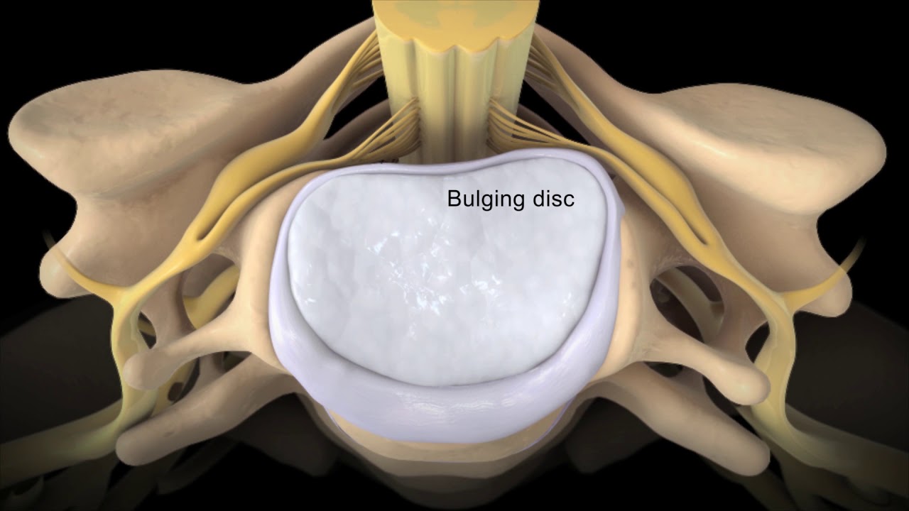 cervical laminoplasty
