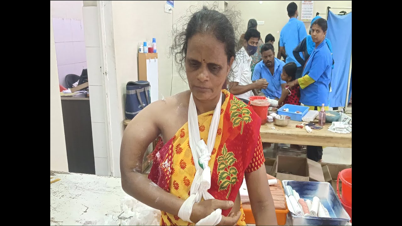 Puttur kattu  மேல் கை எலும்பு துண்டாக உடைந்தவர் | Humerous Bone Fracture Treatment Without Surgery