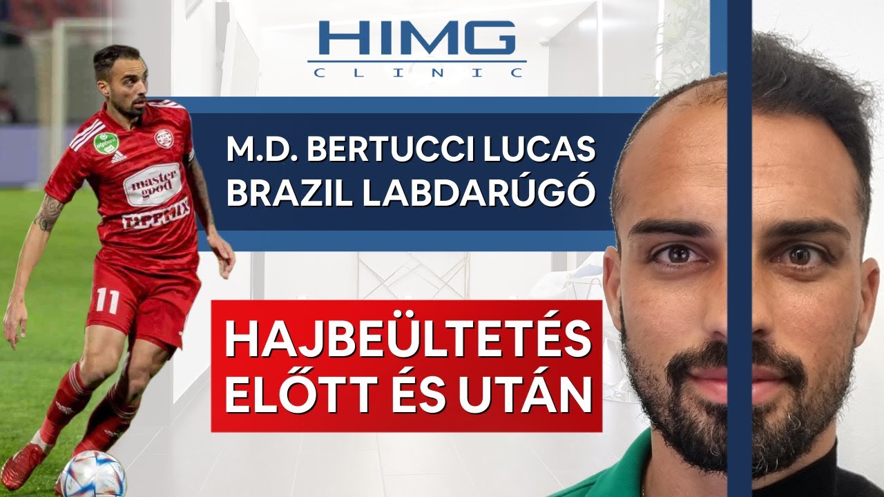 Hajbeültetés előtte utána: M.D. Bertucci Lucas - HIMG Hajbeültetési Klinika