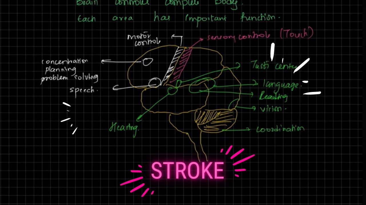 UNDERSTANDING BRAIN STROKE🧠