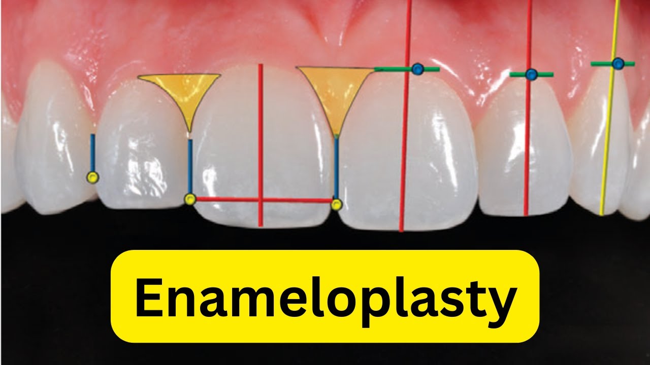 What is enameloplasty or odontoplasty?