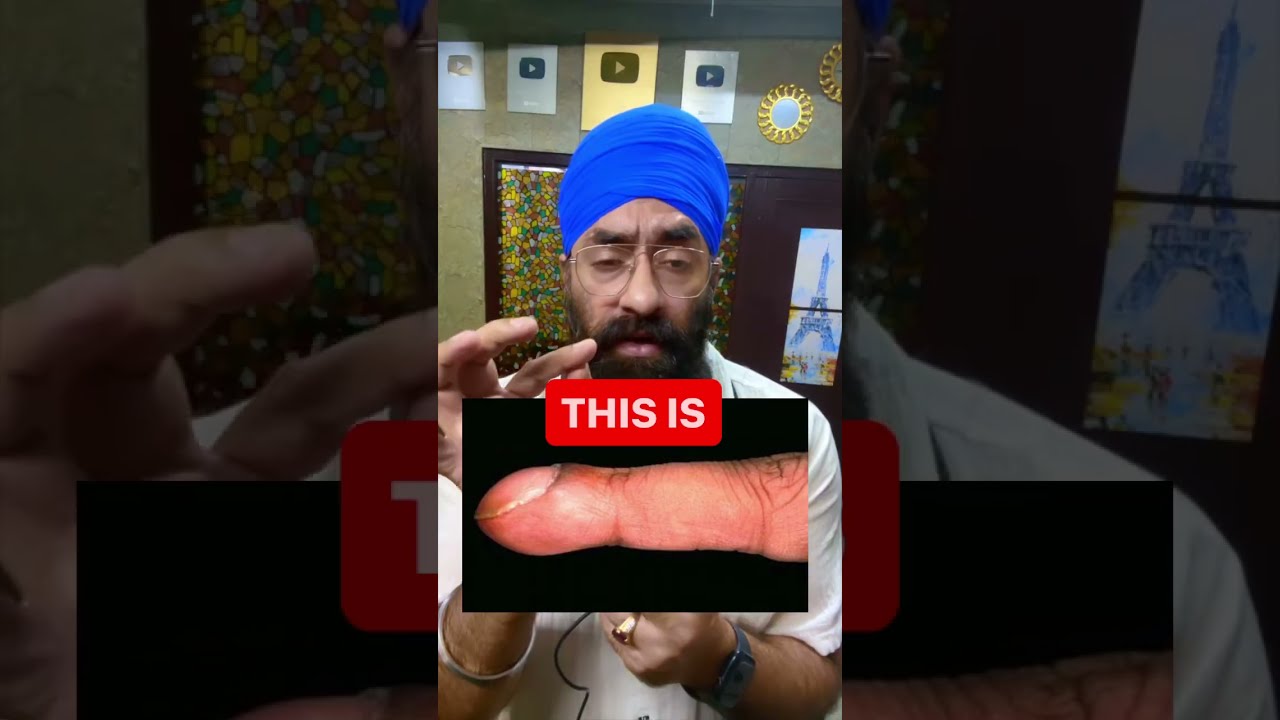 Digital clubbing aka clubbed fingers or fingers clubbing | Dr. Education