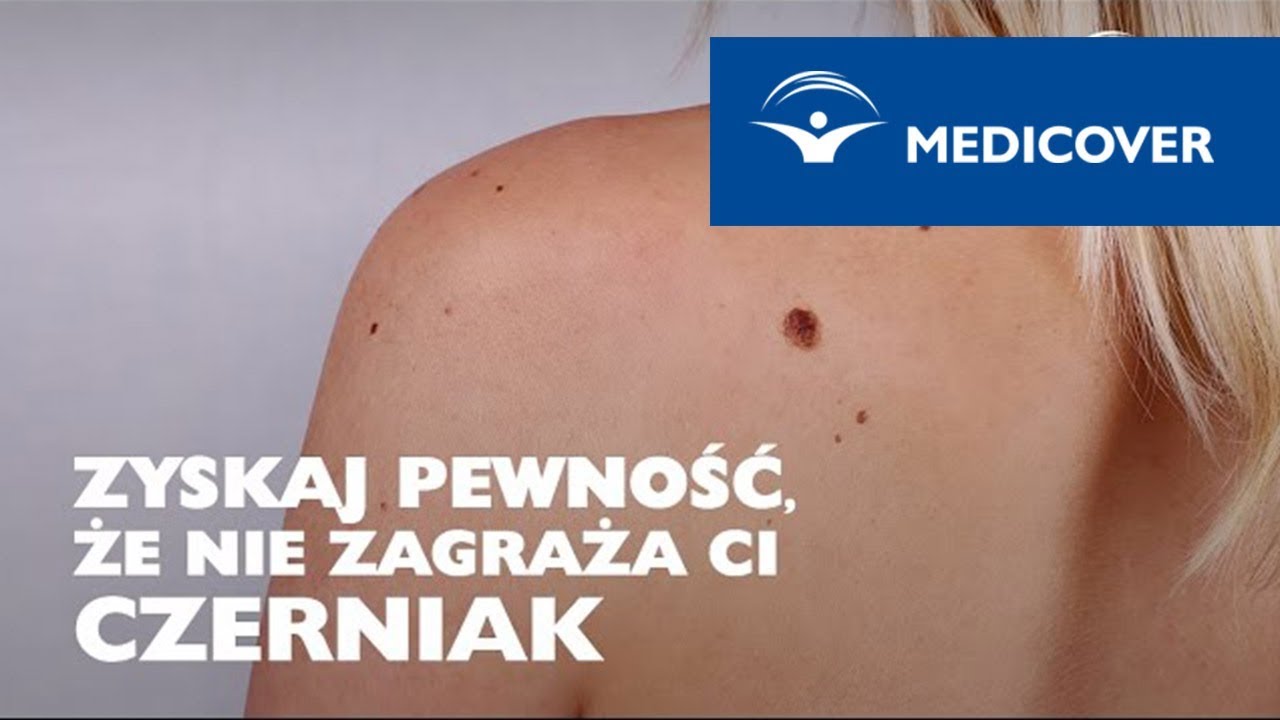 Czerniak? Badaj znamiona i pieprzyki wideodermoskopem