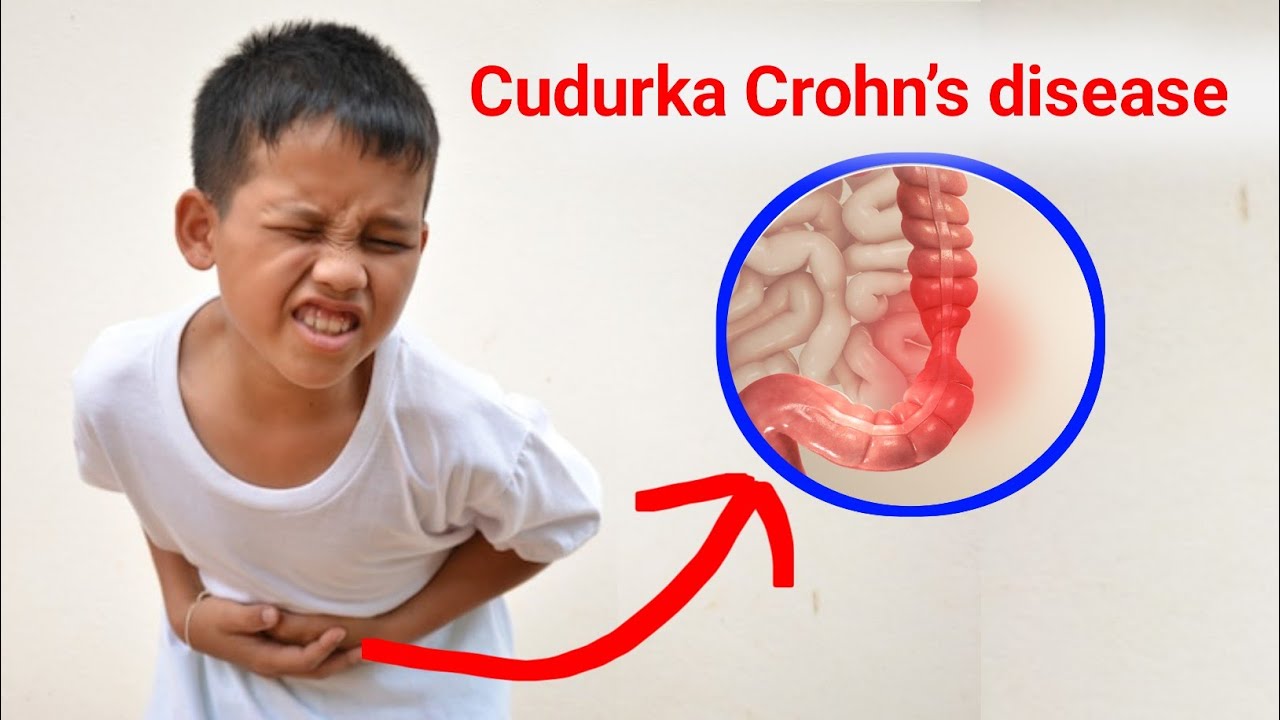 Xanuunka Crohn&rsquo;s disease  sababta xanuunka Gaaska loogu qaldo calaamadaha 