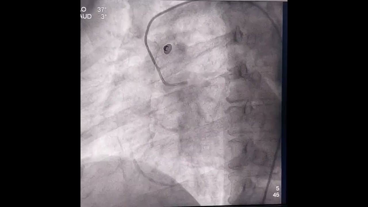 Angioplasty of anomalous RCA (arising from left coronary sinus)