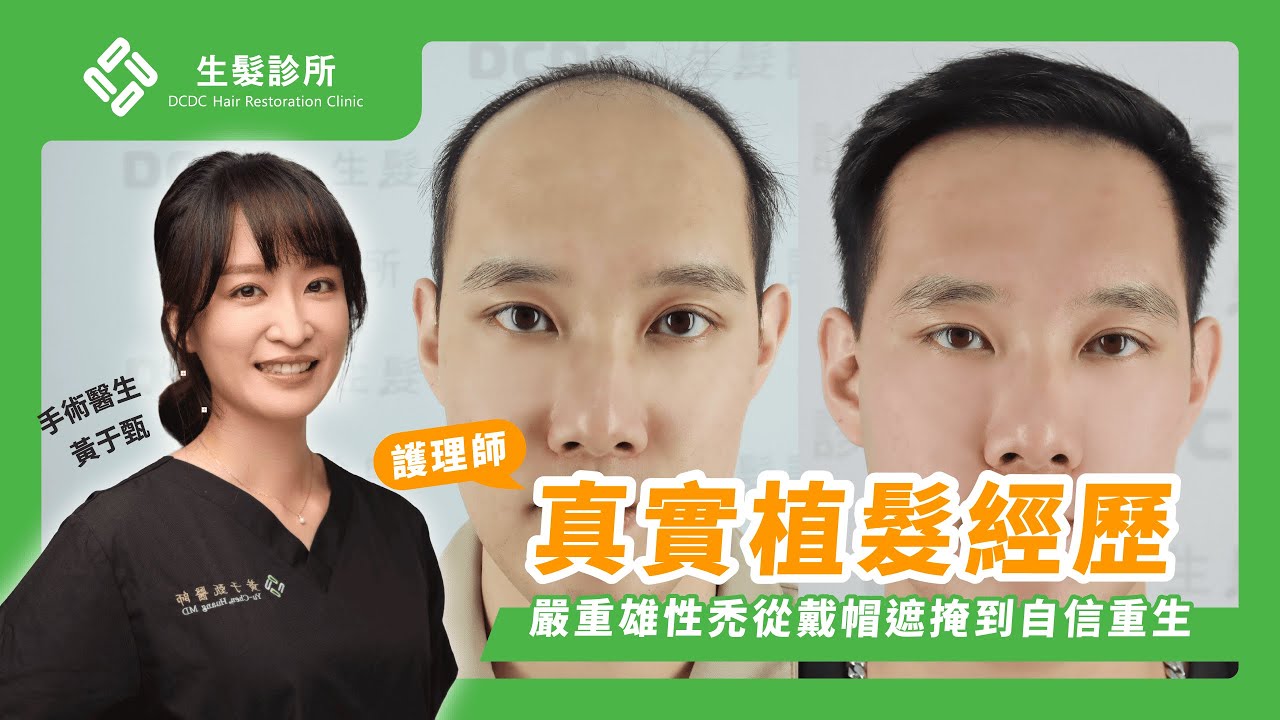 【植友分享】27歲嚴重雄性禿：護理師真實植髮經歷，從戴帽遮掩到自信重生｜ #黃于甄醫師 #dcdc生髮診所