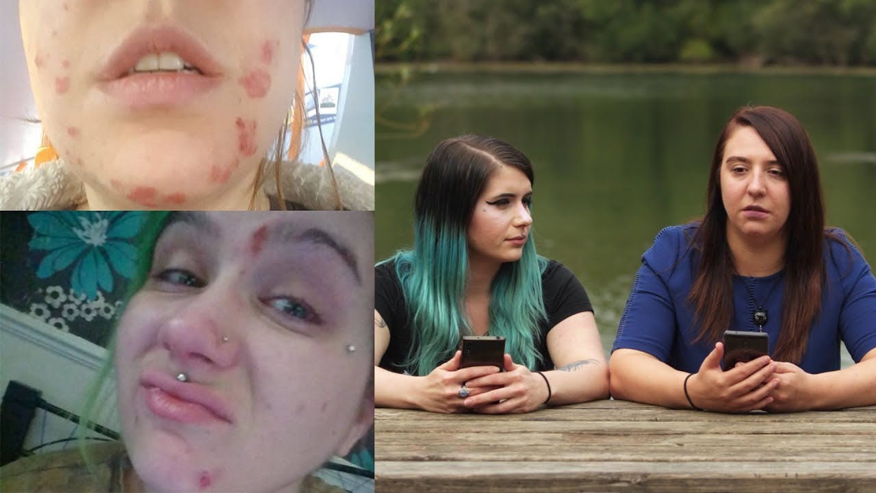 Skin Picking Disorder (Dermatillomania)