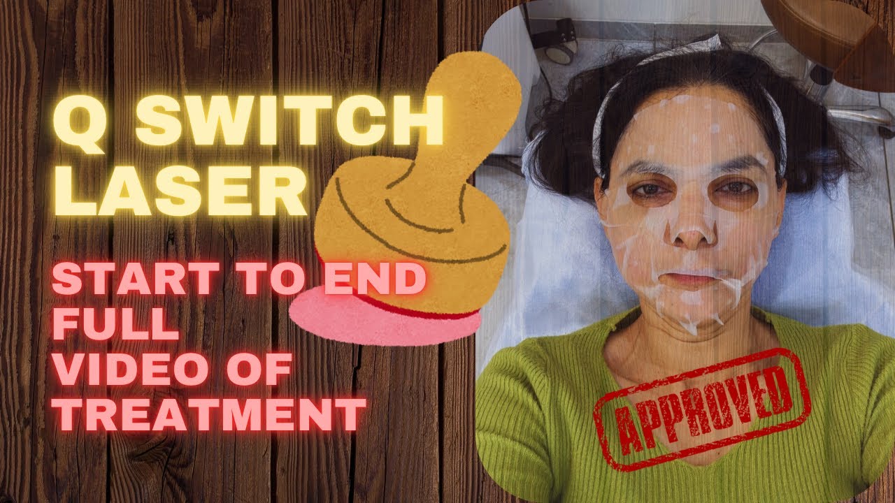 Q SWITCH LASER TREATMENT | NIILAM SUTHAAR | LASER SKIN FACIAL | ALL ABOUT SKIN