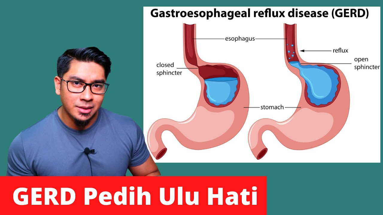 GERD Pedih Ulu Hati I Cara Merawat I Doctor Sani I