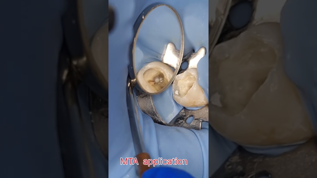 اصلاح انثقاب في قاع الحجزة اللبية perforation
