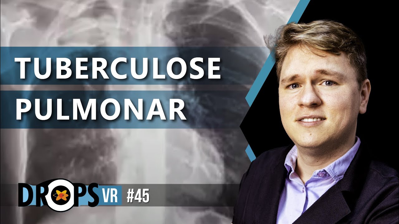 TUBERCULOSE PULMONAR | Aprenda a Reconhecer no Rx  de tórax