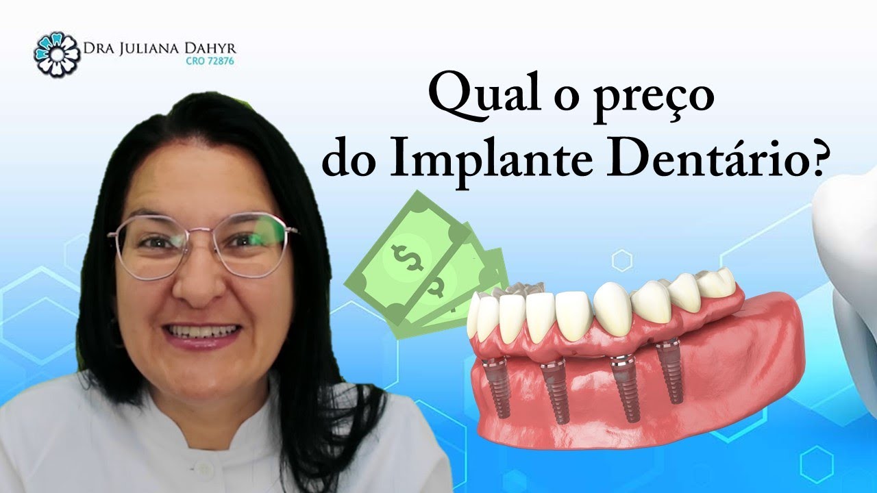 Quanto custa um implante dent&aacute;rio? Saiba nesse v&iacute;deo tudo sobre pre&ccedil;o de um implante dent&aacute;rio!