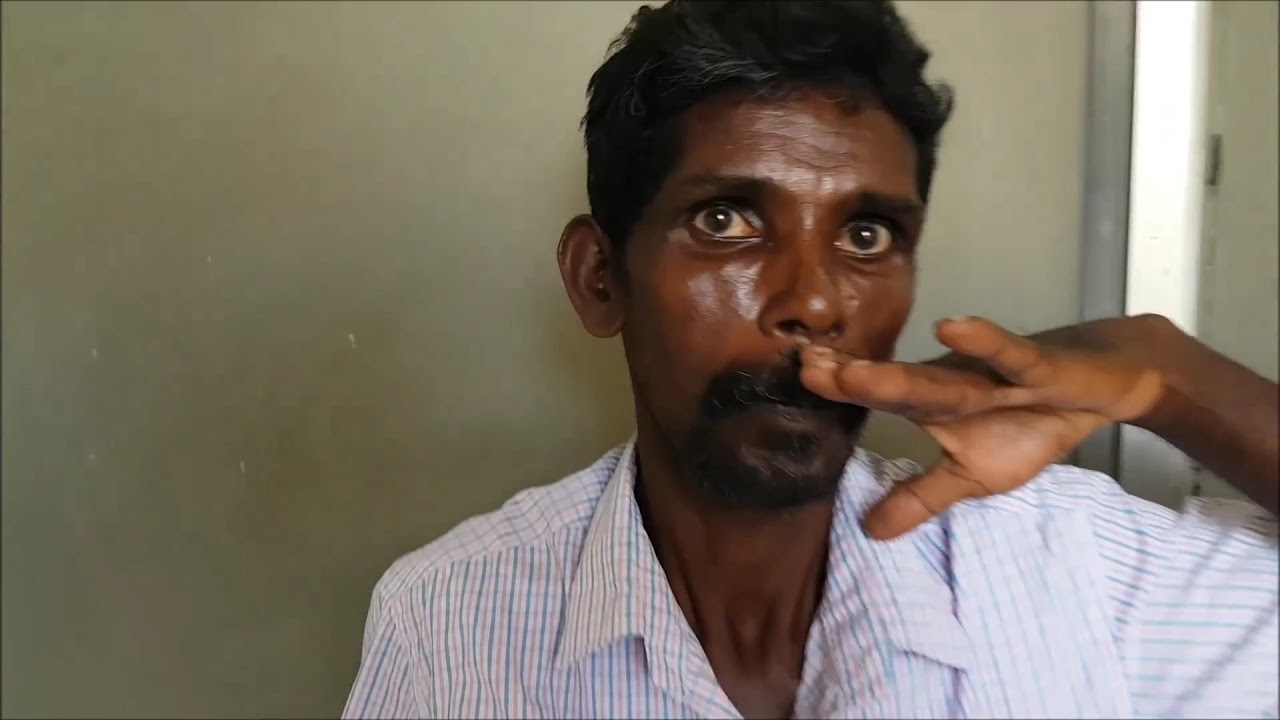 WING BEATING TREMORS, KF RING Wilson’s disease