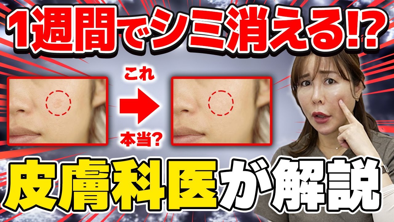 １週間でシミはクリームで消えるの?!美容医療のシミ治療について皮膚科医が真実をお伝えします！ シミ| 肝斑 | ハイドロキノン