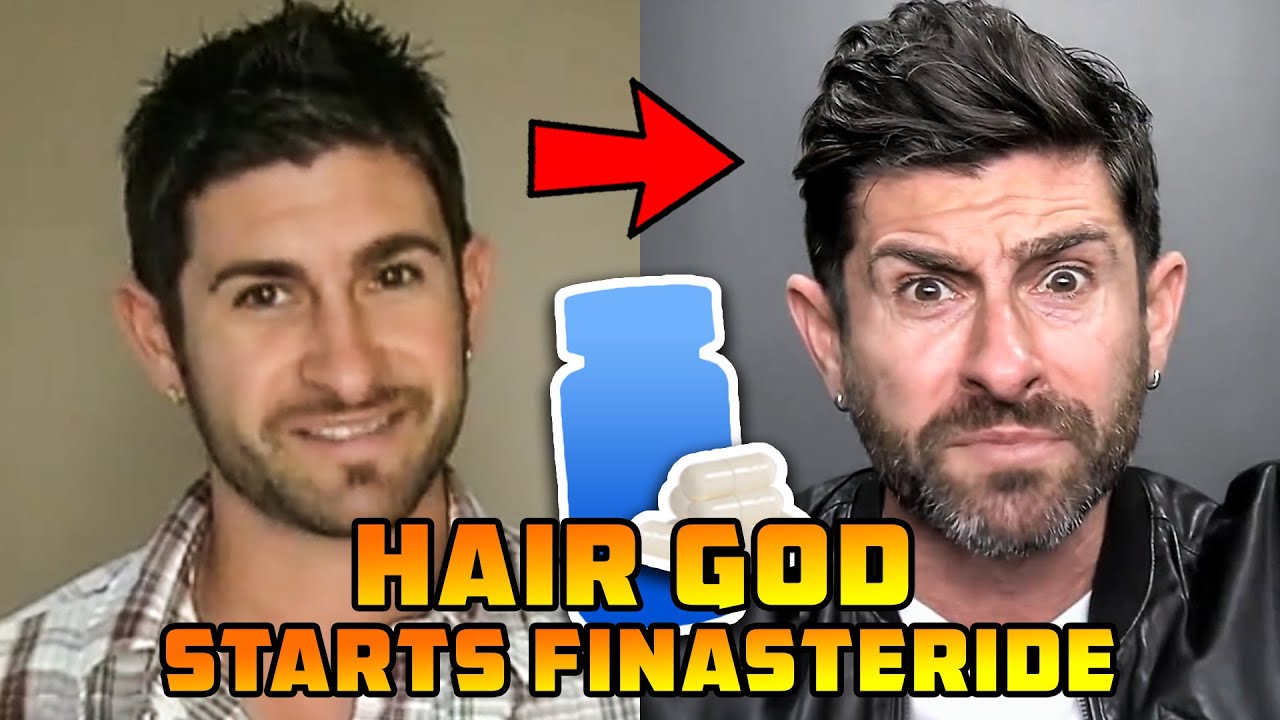 Density King Norwood 0 Hair God Alpha M. Starts Finasteride