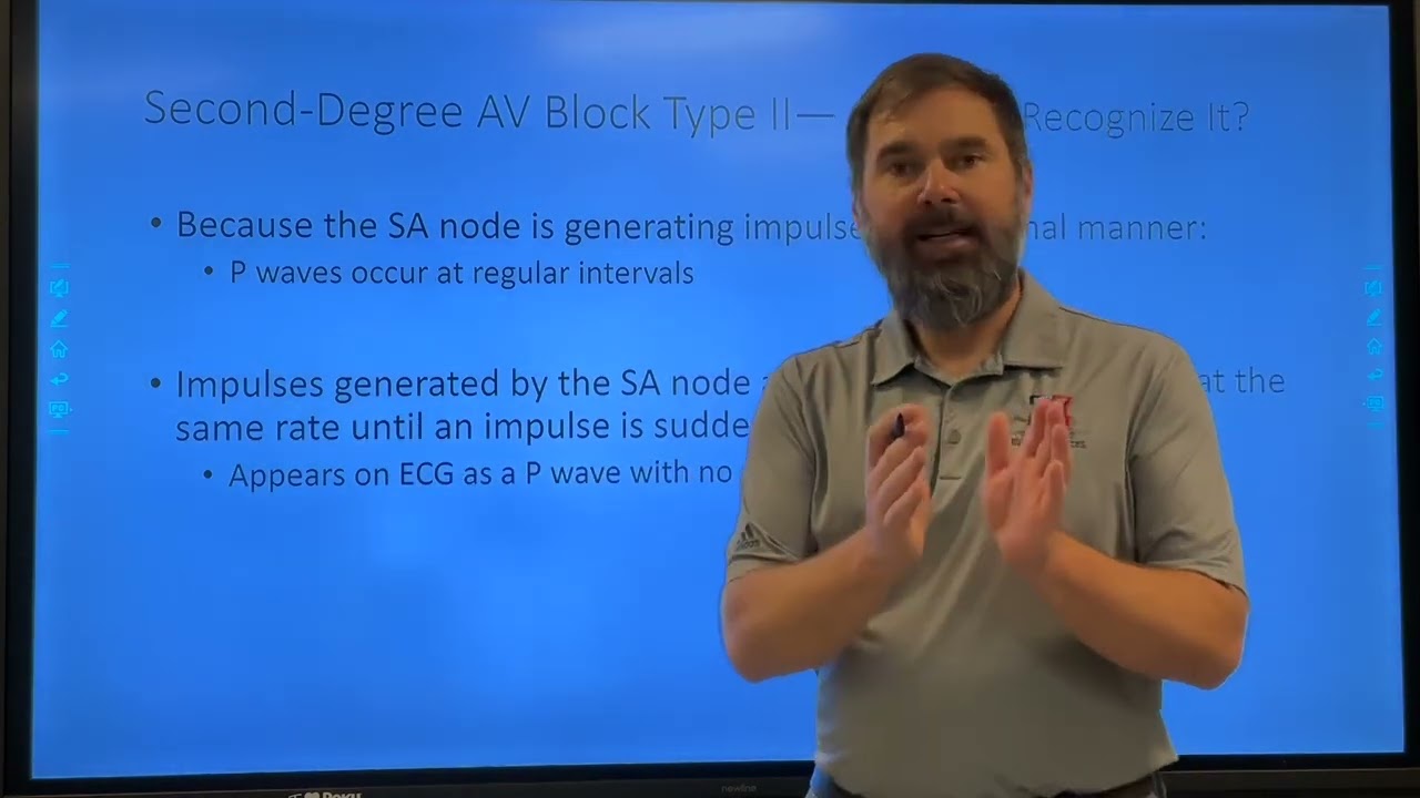 Second degree AV Block Type II Presentation