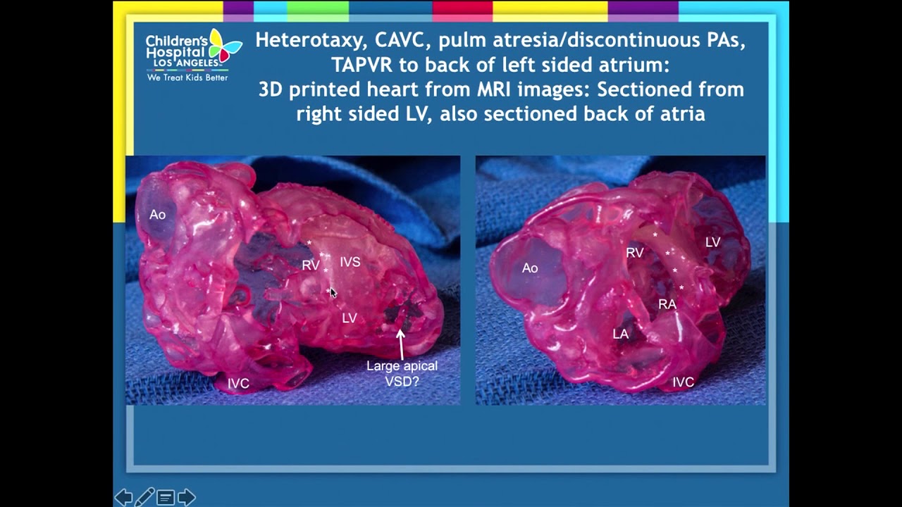 Advanced Echo Imaging in CHD