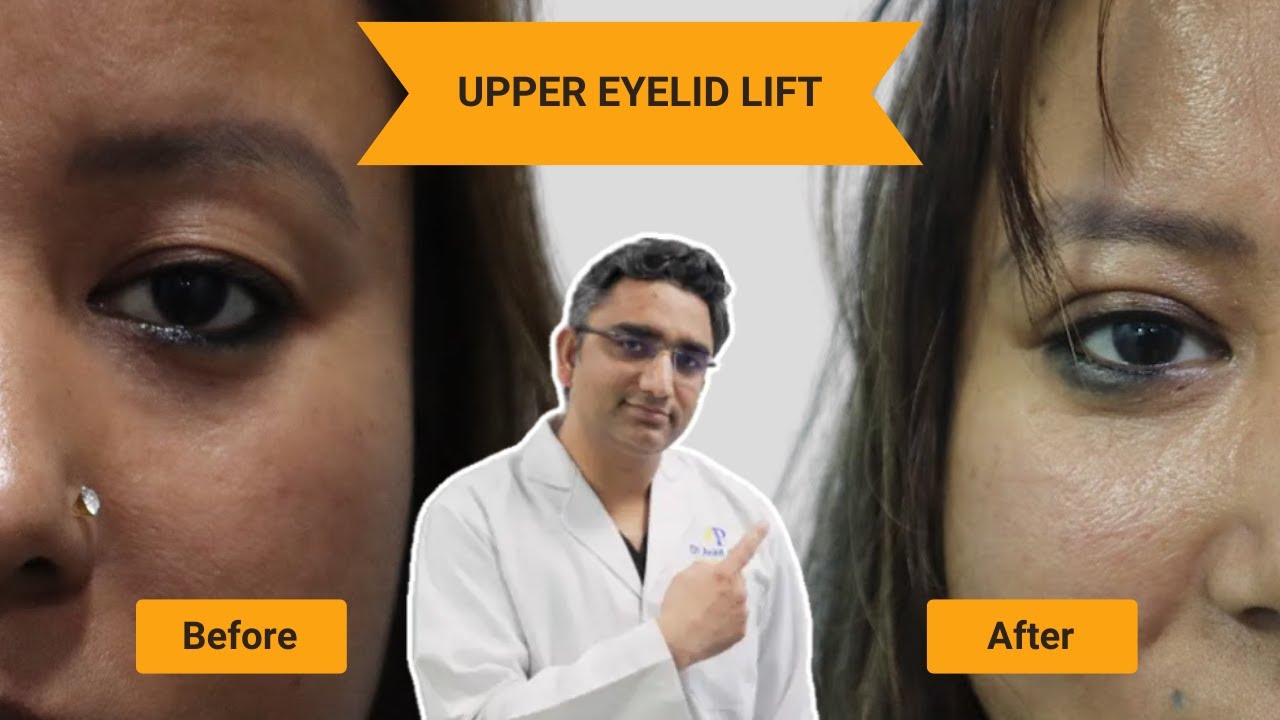 How to Get Rid of Hooded Eyelids - Upper Eyelid Lift - Before After Results #transformation