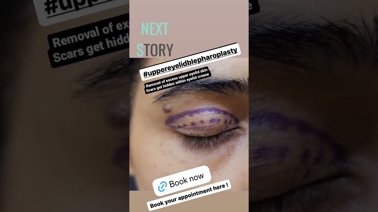 Upper eyelid surgery in Bengaluru |  Blepharoplasty | Immediate results #eyelidsurgery #selfcare