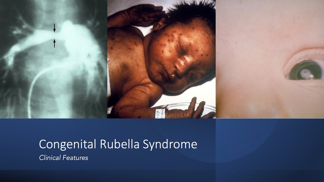 Congenital Rubella Syndrome: Early and Late Onset Manifestations