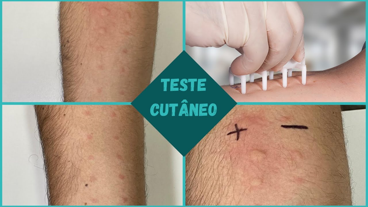 Prick Test Clínica Viver Bem