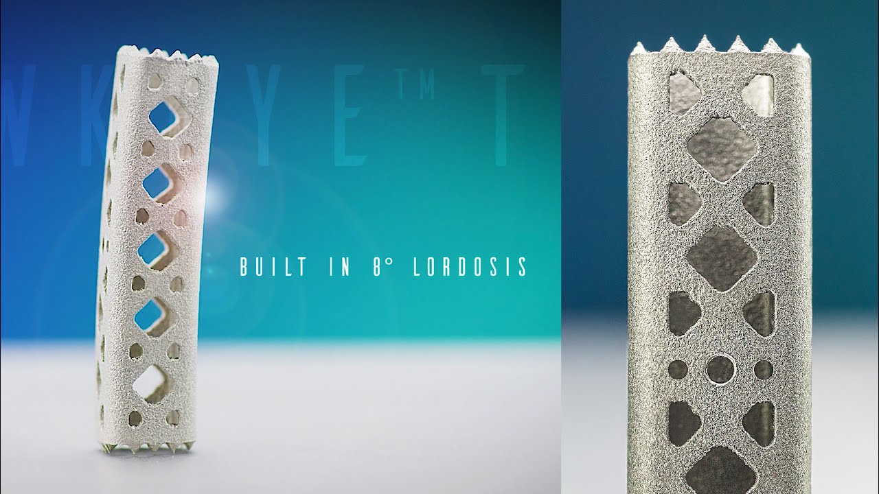 ChoiceSpine's Hawkeye&trade; TI is Changing the Game for Cervical Corpectomy Cases