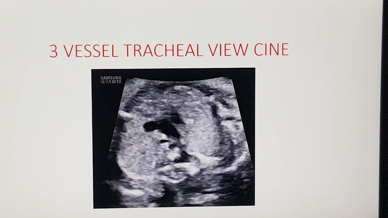 FETAL RIGHT AORTIC ARCH teaching by Dr Pradeep Srinivasan under REFER SERIES