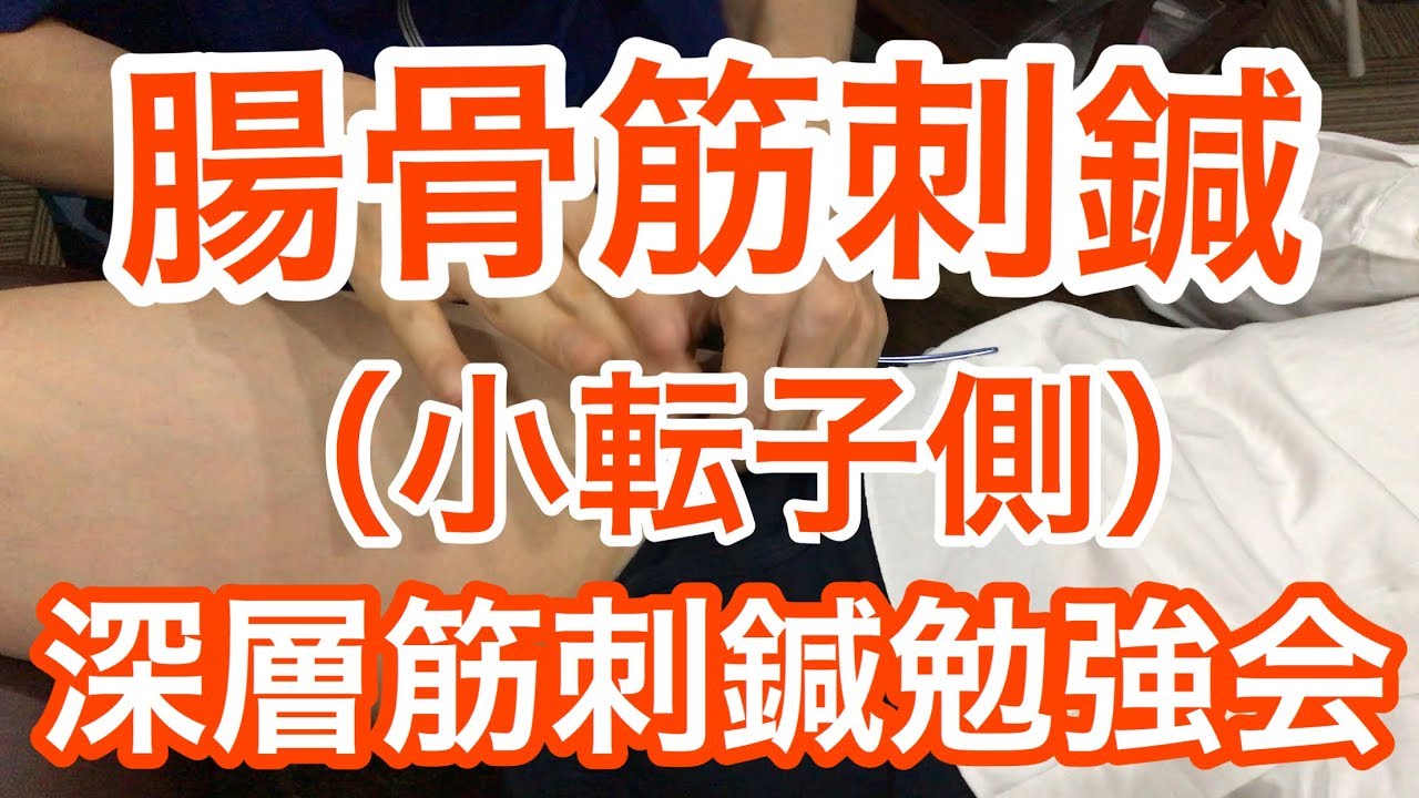 腸骨筋刺鍼（小転子側）インナーマッスル刺鍼