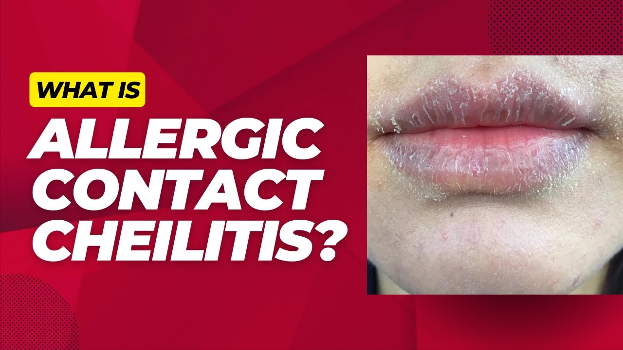 What is allergic contact cheilitis?