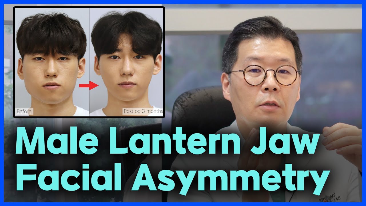 Male Lantern Jaw and Facial Asymmetry Double Jaw Surgery: Here’s How It Was Performed