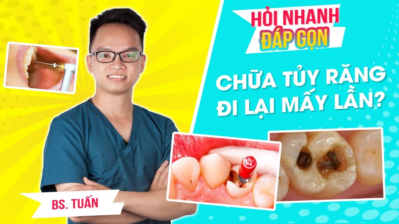 Cần bao nhiêu lần hẹn cho việc chữa tủy một chiếc răng?