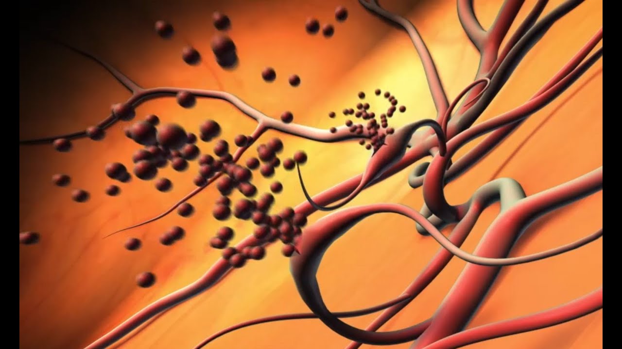 Lucentis effective for proliferative diabetic retinopathy