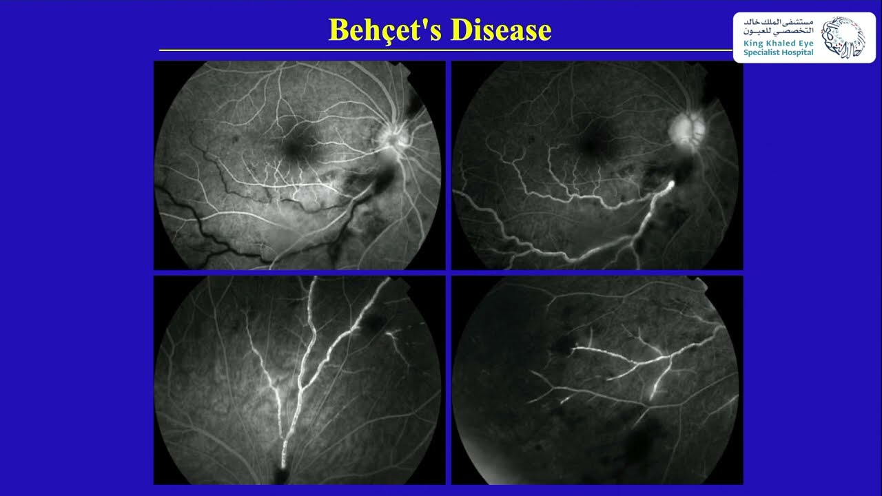 Behcet's Disease
