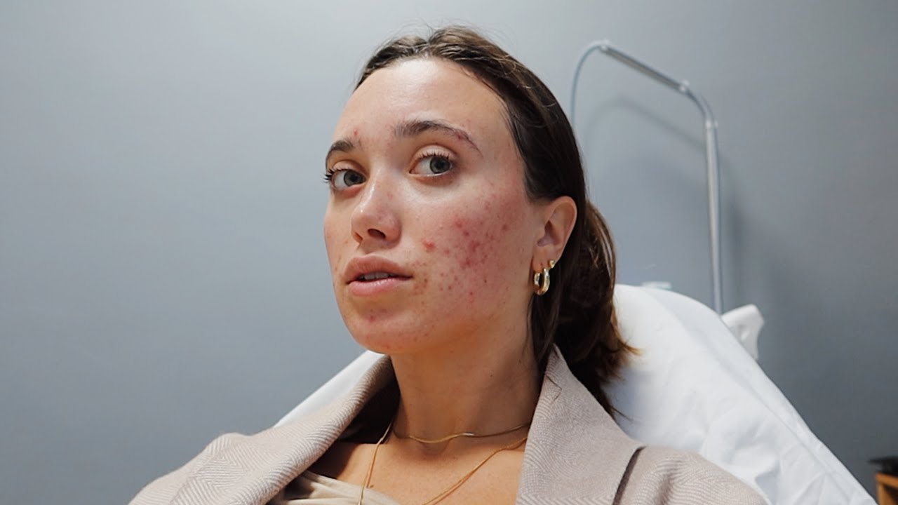 trying to get rid of my acne scars