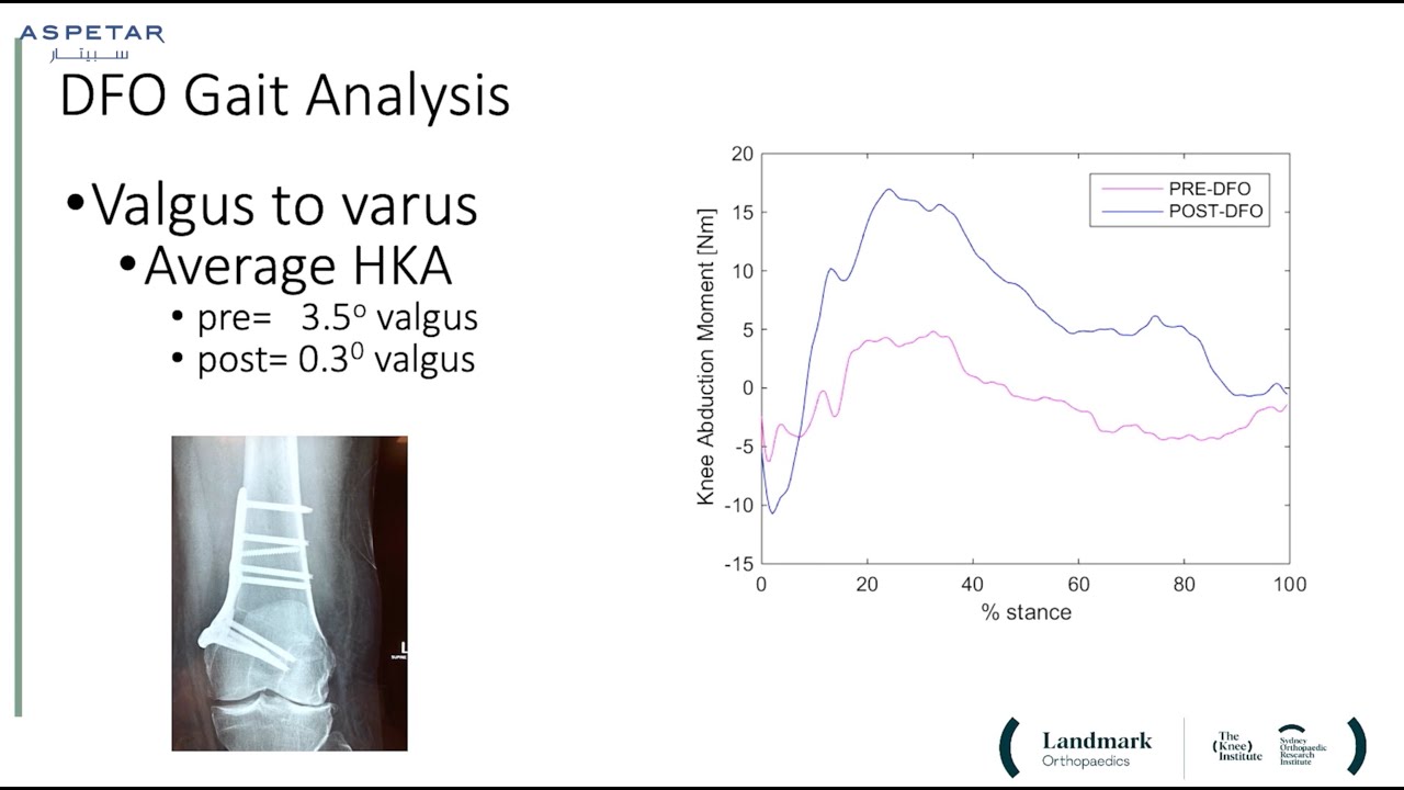 Osteotomy around the knee by Prof David Parker, Director, Sydney Orthopaedic Research Institute