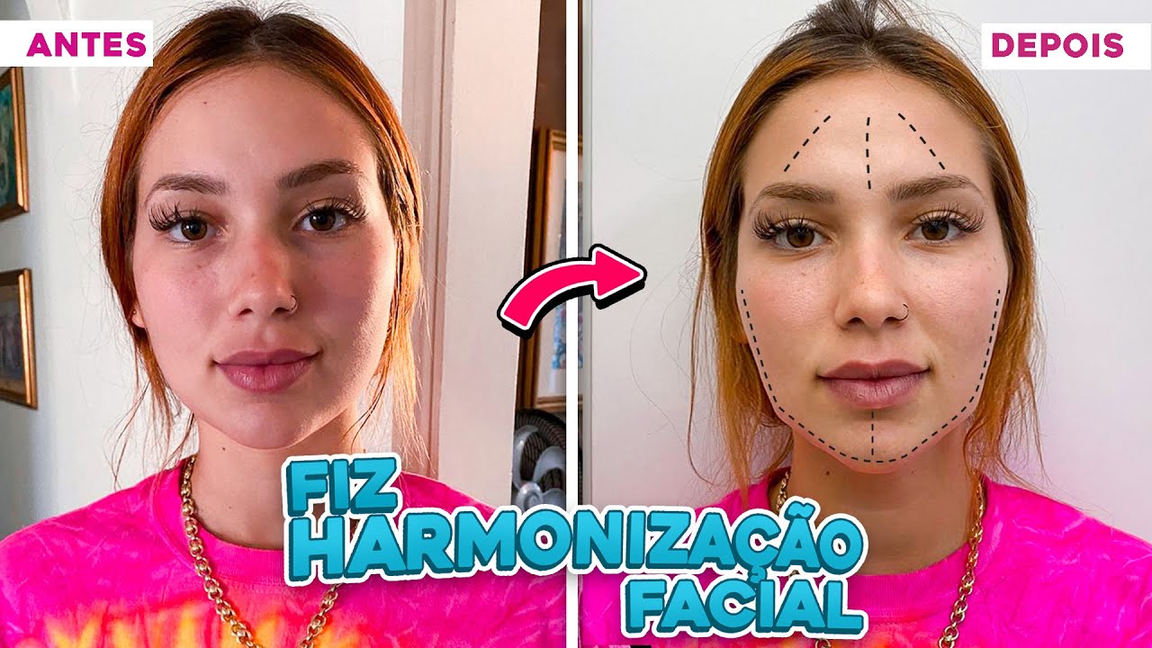 PRIMEIRA VEZ FAZENDO HARMONIZAÇÃO FACIAL!! DEU MUITA DIFERENÇA 😱