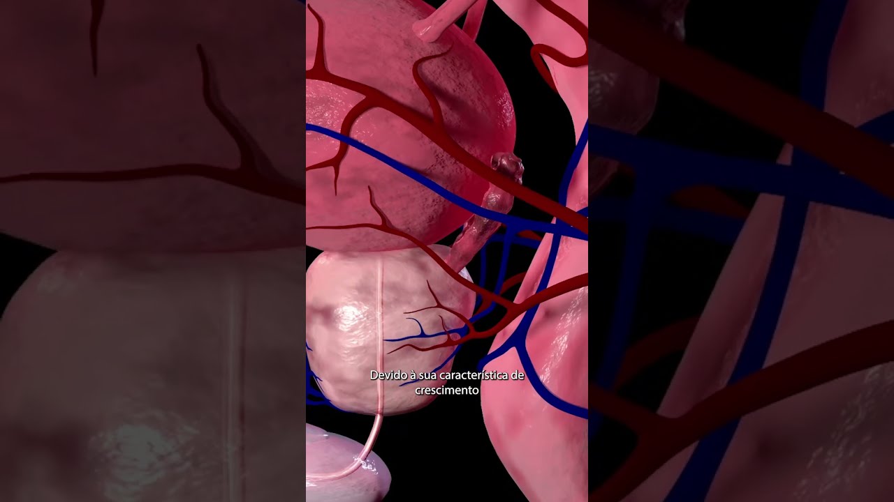 Como o crescimento da próstata afeta a saúde?