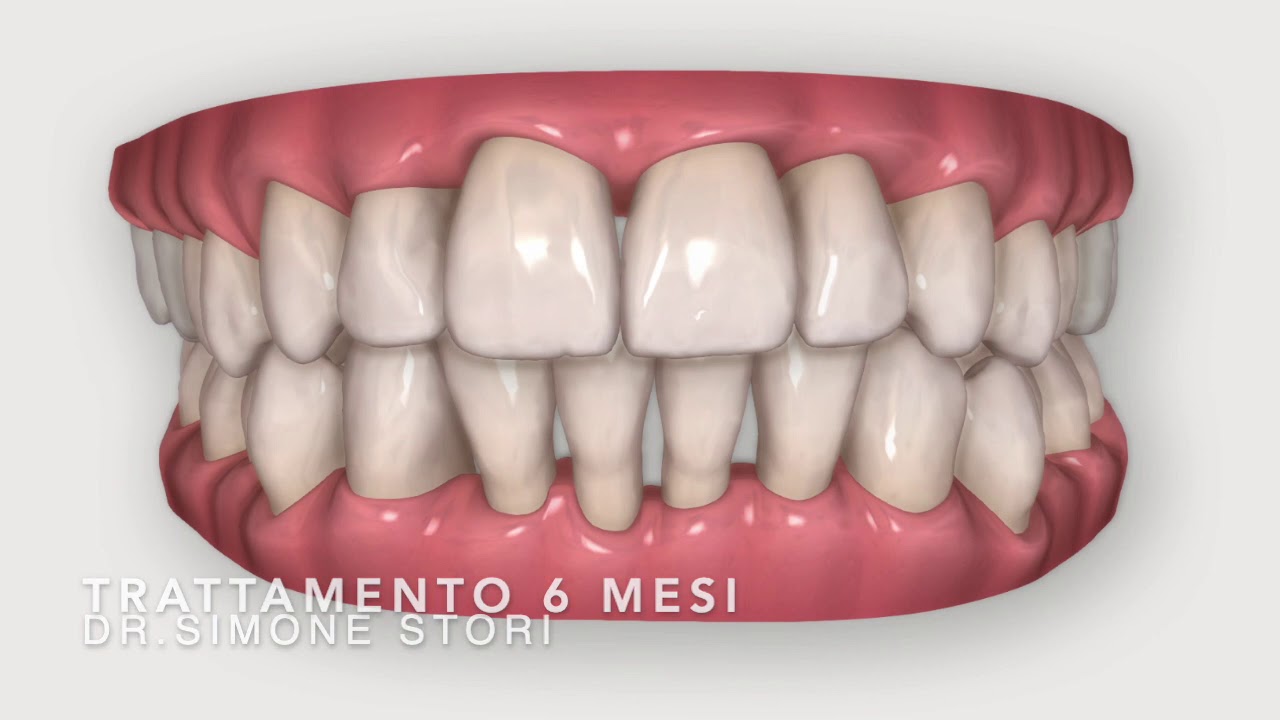 Invisalign Prima e Dopo - Trattamento Mono Arcata - Ortodonzia Bologna