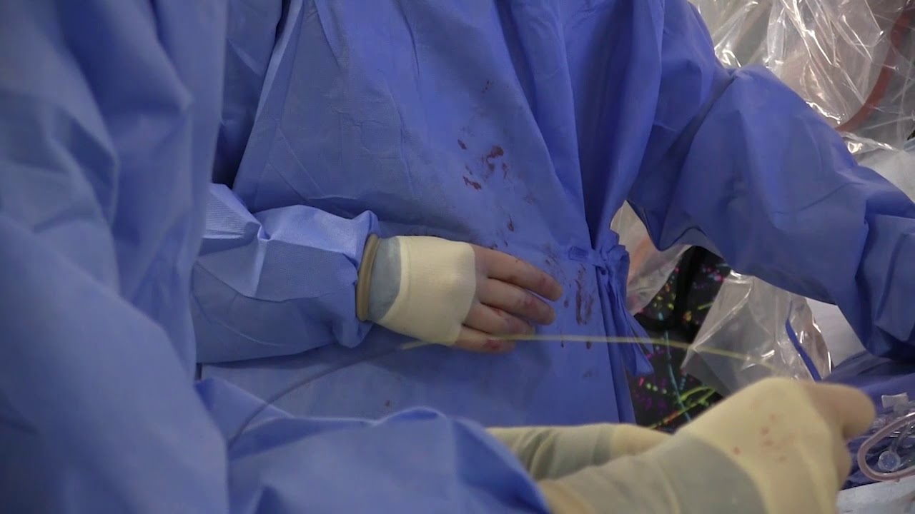 Guidewire Selection for Coronary CTO Procedures at the University Of Colorado Hospital